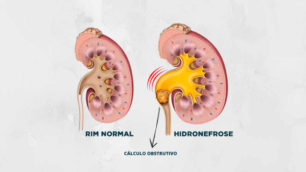 Calculo renal