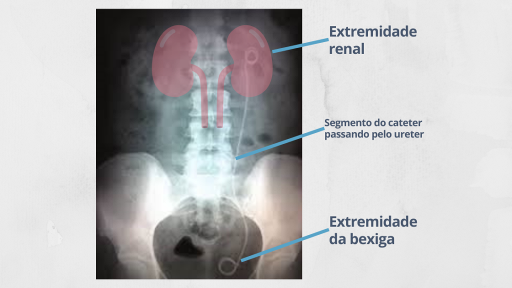 Cateter Duplo J no corpo